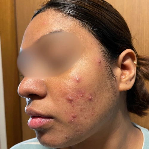 Acne is not just a surface problem