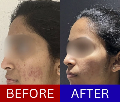 Acne scar correction before and after — 5-year case treated through a staged scar protocol over 6 months