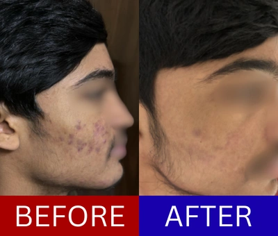 Mixed atrophic scars before and after — staged scar-correction protocol
