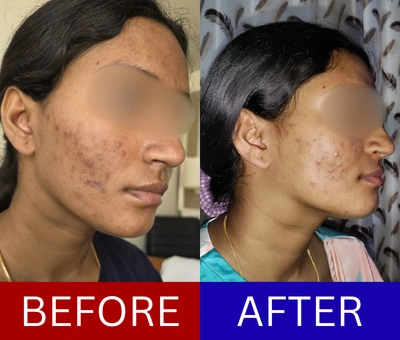 Rolling and boxcar scars before and after — sequenced resurfacing and tethering release